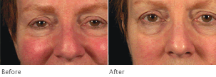 Clarisonic Sensitive Skin- Before and After Photos